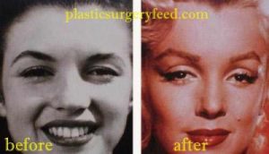 Marilyn Monroe Nose Job Rhinoplasty