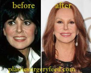 Marlo Thomas Facelift