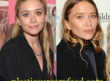 Mary-Kate Olsen Nose Job