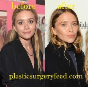 Mary-Kate Olsen Nose Job