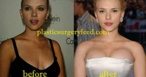 Scarlett Johansson Breast Implant