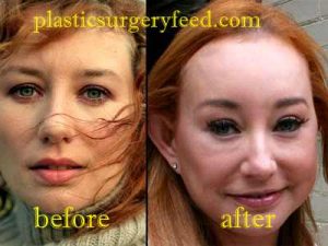 Tori Amos Eyelift Surgery