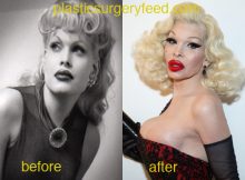 Amanda Lepore breast before and after surgery