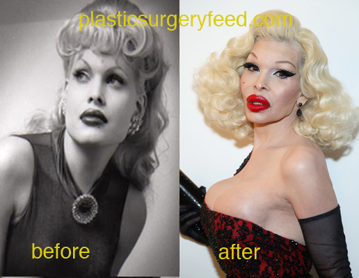 Amanda Lepore breast before and after surgery