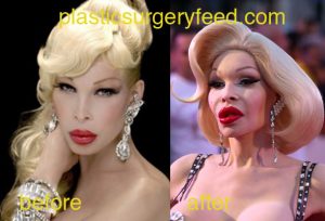 Amanda Lepour before and after botox