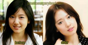 Park Shin Hye Cosmetic Surgery 1