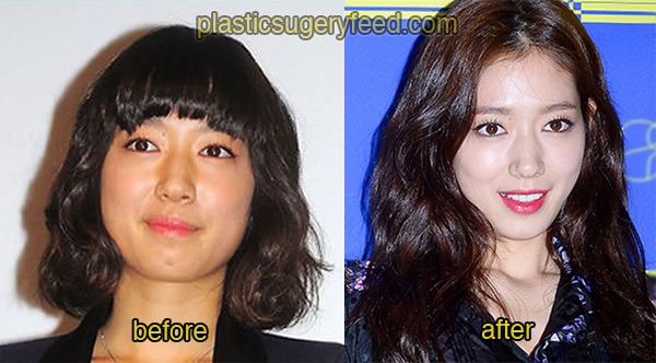 Park Shin Hye Cosmetic Surgery 2