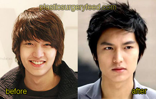 Lee Min Ho Plastic Surgery Feed 1