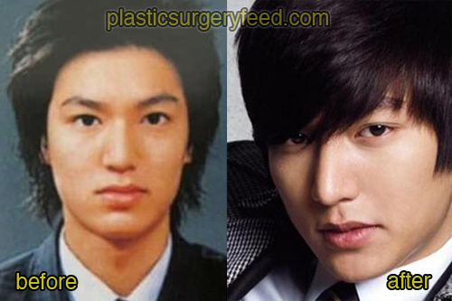 Lee Min Ho Plastic Surgery Feed 2