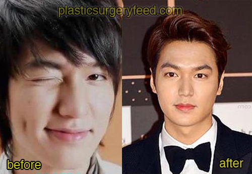 Lee Min Ho Plastic Surgery Feed 3