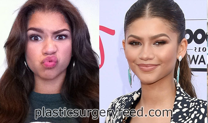 zendaya nose job plastic surgery