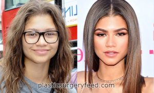 zendaya underwent plastic surgery