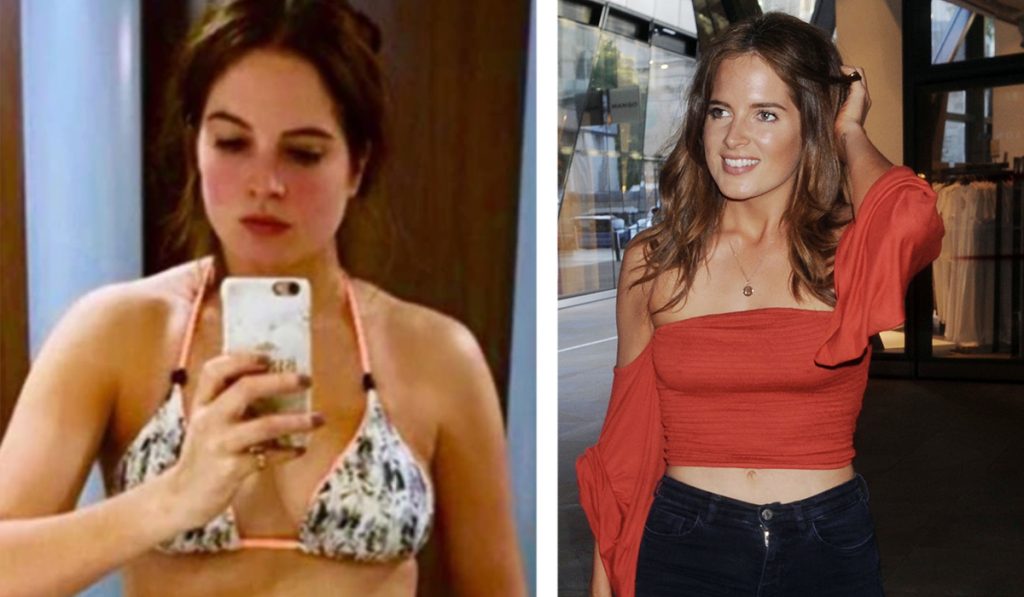 Binky Felstead Cosmetic Surgery Body